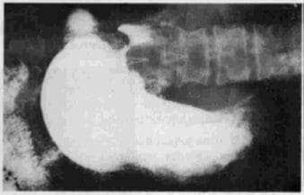 Estenosis por úlcera pilórica