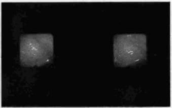 Gastritis atrófica