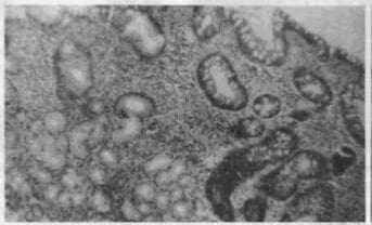Gastritis atrófica