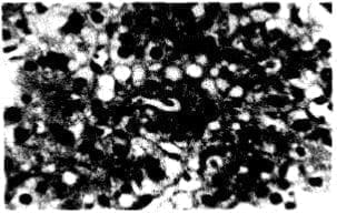Necrosis
