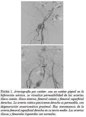 Arteriografía por catéter