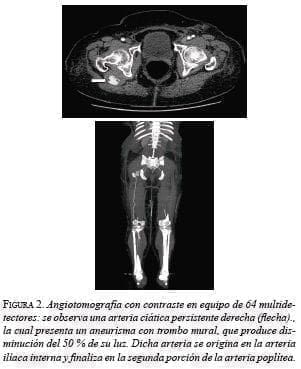 Angiotomografía con contraste