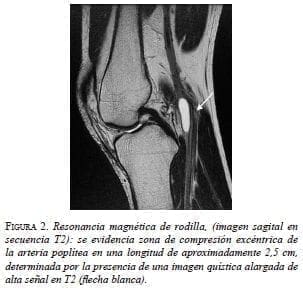 Resonancia magnética de rodilla