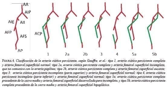 Clasificación de la arteria ciática persistente
