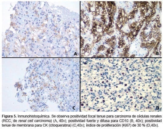 Carcinoma de cédulas renales