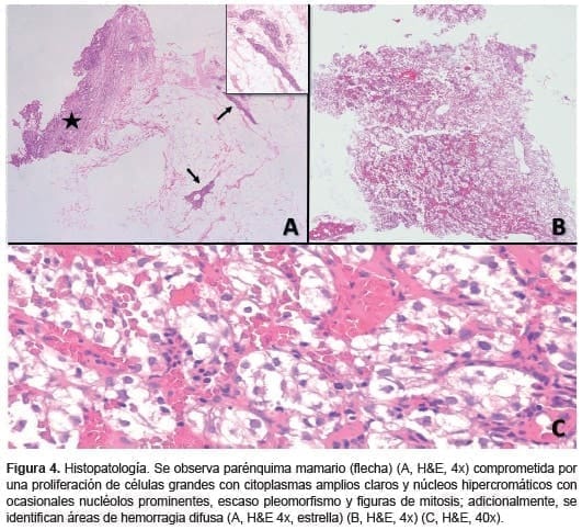 Carcinoma de células claras renales, Parénquima mamario