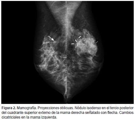 Carcinoma de células claras renales, Proyecciones oblicuas Carcinoma de células claras renales, Proyecciones oblicuas