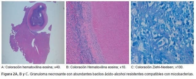 Granuloma necrosante con abundantes bacilos ácido-alcohol