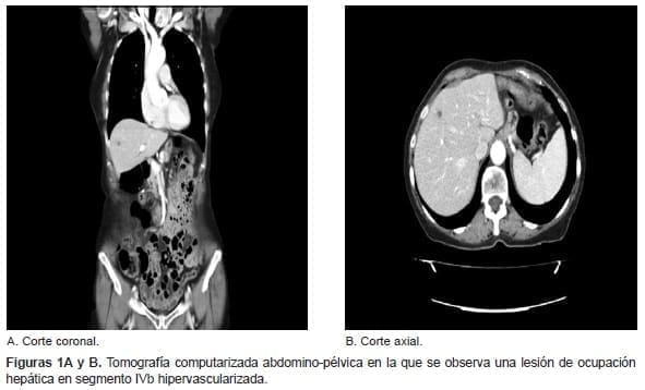 Lesión de ocupación hepática