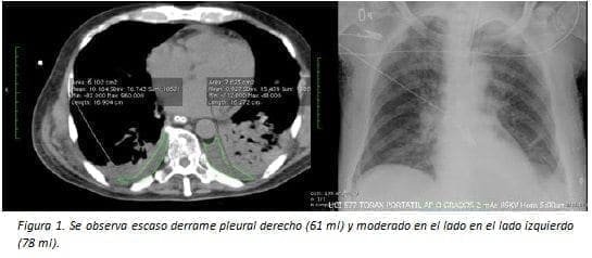 Derrame Pleural Derecho (61 ml)