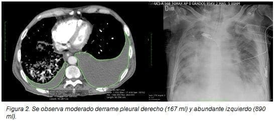 Derrame Pleural Derecho (167 ml)