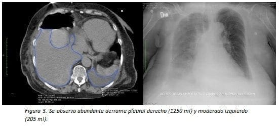Derrame Pleural Derecho (1250 ml)