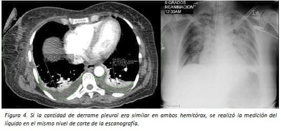 Derrame Pleural, Similar en Ambos Hemitórax