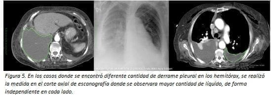 Derrame Pleural en los Hemitórax