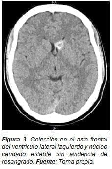 Núcleo Caudado estable sin evidencia de Resangrado Núcleo Caudado estable sin evidencia de Resangrado