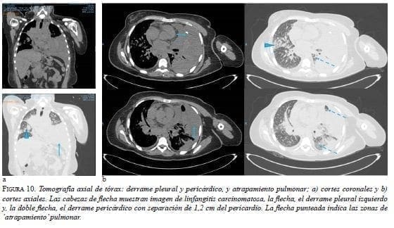 Derrame Pleural y Pericárdico Derrame Pleural y Pericárdico