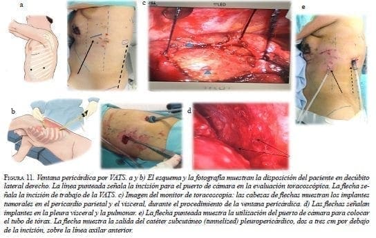 Ventana Pericárdica por VATS