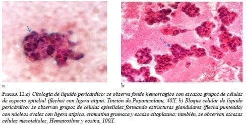 Citología de Líquido Pericárdico Citología de Líquido Pericárdico