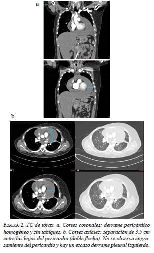 Escaso Derrame Pleural Izquierdo