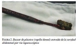 Bezoar de Plástico extraído de la Cavidad Abdominal
