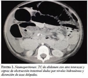 Neumoperitoneo: TC de Abdomen