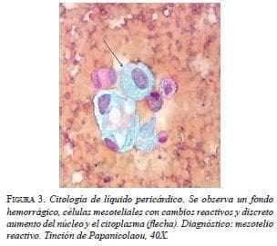 Citología de Líquido Pericárdico