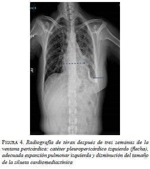 Catéter Pleuropericárdico Catéter Pleuropericárdico