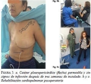 Catéter Pleuropericárdico Permeable