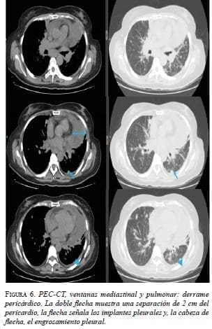 ventanas Mediastinal y Pulmonar
