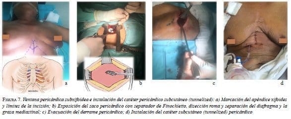 Ventana Pericárdica Subxifoidea
