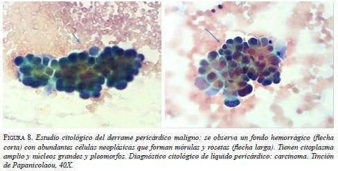 Estudio Citológico del Derrame Pericárdico Maligno