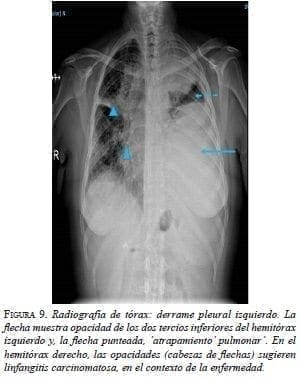 Radiografía de Tórax: Derrame Pleural