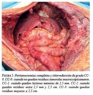 Peritonectomías Completas y Citorreducción