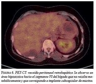 Recaída Peritoneal Retrohepática