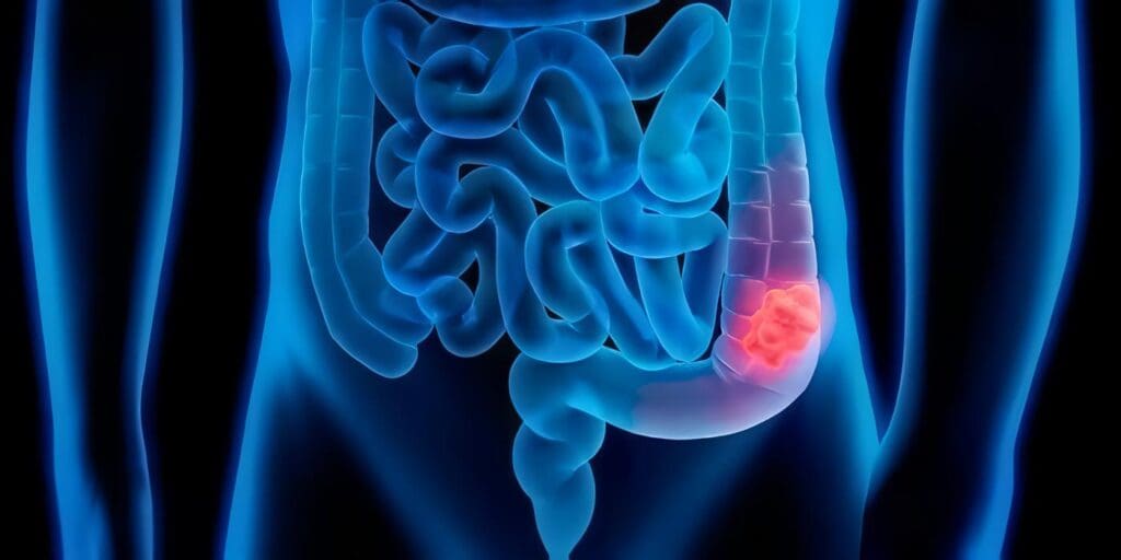 Diagnóstico de Cáncer de Colon y Recto, Seguimiento