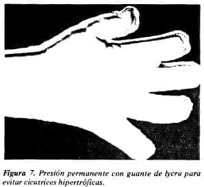 Guante de lycra para evitar cicatrices hipertróficas