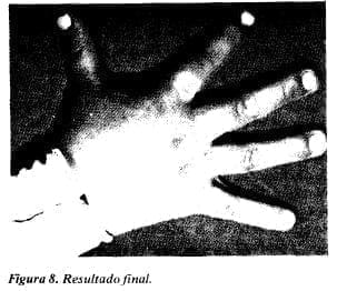 Tratamiento de La Mano Quemada