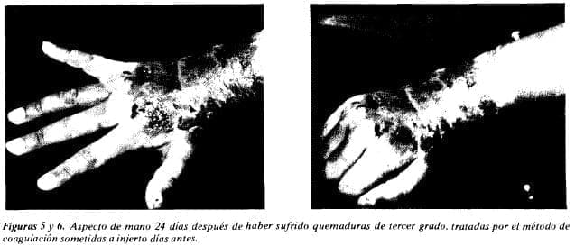 24 días después de haber sufrido quemaduras de tercer grado