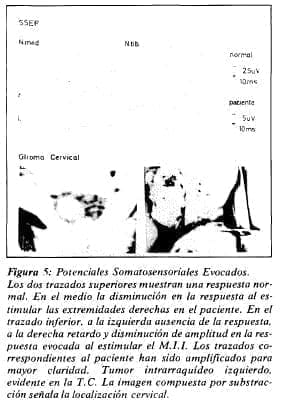 Glioblastoma infiltrativo