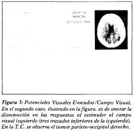 Tumor parieto-occipital derecho