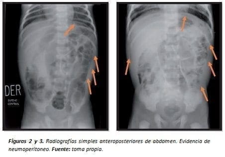 Evidencia de Neumoperitoneo