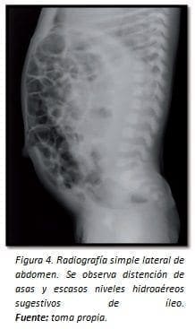 Distención de Asas y Escasos Niveles Hidroaéreos