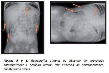 Evidencia de Neumoperitoneo
