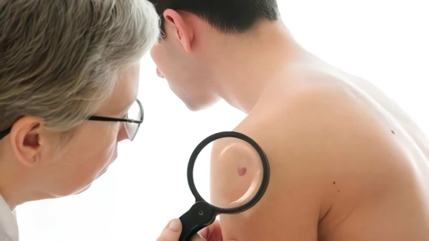 Carcinoma Basocelular