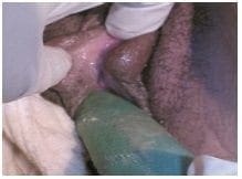 Técnica simplificada de neovagina