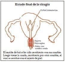 Técnica simplificada de Neovagina y neocérvix