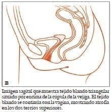 Muestra tejido blando triangular