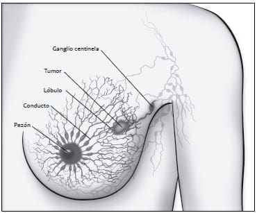 Masa formándose en la mama