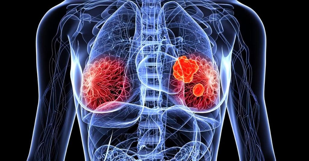 Guía para el Manejo del Carcinoma Mamario no Invasivo