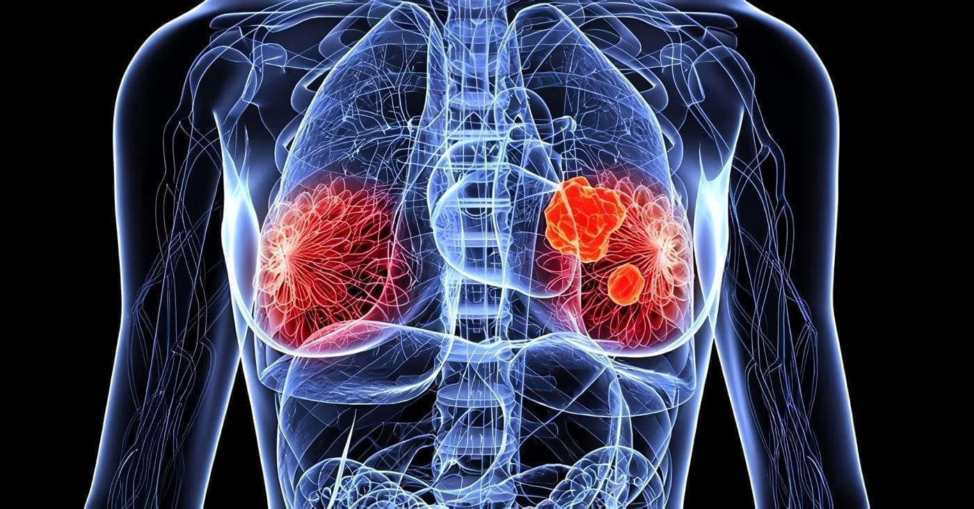 Tipos de cáncer de mama